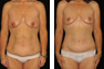 Tummy Tuck and Breast Lift following Massive Weight Loss