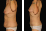 Tummy Tuck and Breast Lift following Massive Weight Loss
