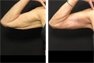Arm Lift (following Massive Weight Loss)