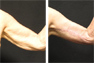Arm Lift (following Massive Weight Loss)