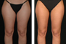 Liposuction of the Outer Thighs, Inner Thighs, and Calves