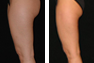 Liposuction of the Outer Thighs, Inner Thighs, and Calves