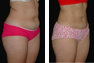 Liposuction of the Abdomen, Hips, and Flanks
