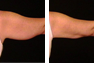 Liposuction of the Arms