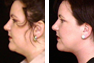 Liposuction underneath the chin