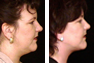 Liposuction underneath the chin