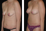 Breast Augmentation (Nipple Incision) Periareolar Lift, Tummy Tuck, Liposuction of the Hips (Mommy Makeover)