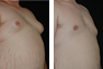 Male Breast Reduction via Liposuction of Chest with subsequent removal of breast glandular tissue