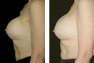Breast Revision for Capsular Contracture with submuscular repositioning and placement of new 400 cc gel implants