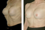 Breast Revision for Capsular Contracture with submuscular repositioning and placement of new 400 cc gel implants