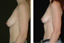Left Periaeolar (Nipple Incision only) Breast Lift