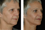 Facelift, Endoscopic Browlift, Upper and Lower  Eyelid Surgery, Fat Grafting, Canthopexy