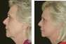 Facelift, Upper & Lower Eyelid Surgery, Fat Grafting