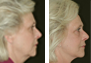 Facelift, Upper & Lower Eyelid Surgery, Fat Grafting