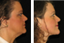 Facelift, Chin Implant, Fat Grafting