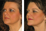 Necklift and Fat Grafting following Massive Weight Loss