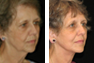Facelift and Fat Grafting
