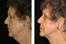 Facelift and Fat Grafting