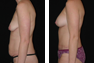Breast Augmentation (Nipple Incision) Periareolar Lift, Tummy Tuck, Liposuction of the Hips (Mommy Makeover)