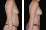 Breast Augmentation & Lift Through Nipple (Periareolar) Incision, Tummy Tuck, Liposuction of the Hips (Mommy Makeover)