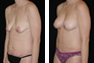 Breast Augmentation & Lift Through Nipple (Periareolar) Incision, Tummy Tuck, Liposuction of the Hips (Mommy Makeover)