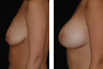 Breast Augmentation & Lift Through Nipple (Periareolar) Incision, Saline Implants 400cc 