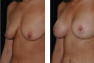 Breast Augmentation & Lift Through Nipple (Periareolar) Incision, Saline Implants 400cc 