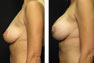 Breast Augmentation (Subglandular) & Lift Through Nipple Incision, Gel Implants, 255cc