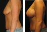 Breast Augmentation (Nipple Incision) Mentor Saline Implants 350 cc 
