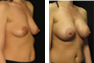 Breast Augmentation (Nipple Incision) Mentor Memory Gel Implants R:325cc and L:350cc