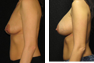 Breast Augmentation (Nipple Incision) Mentor Memory Gel Implants R:325cc and L:350cc