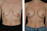 Breast Augmentation (Nipple Incision) Mentor Saline Implants 400cc 