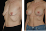 Breast Augmentation (Nipple Incision) Mentor Saline Implants 400cc 