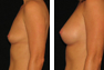 Breast Augmentation (Armpit Incision) Mentor Memory Gel Implants 325cc