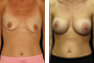 Breast Augmentation (Nipple Incision), Saline Implants 350cc