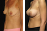 Breast Augmentation (Nipple Incision), Saline Implants 350cc