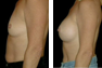 Breast Augmentation (Armpit Incision) Mentor Saline Implants 325cc