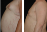 Male Breast Reduction via Liposuction of Chest with subsequent removal of breast glandular tissue