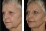 Facelift, Endoscopic Browlift, Upper and Lower  Eyelid Surgery, Fat Grafting, Canthopexy
