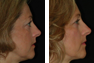 Upper and Lower Eyelid Surgery 