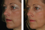 Upper and Lower Eyelid Surgery 