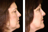 Upper and Lower Eyelid Surgery, Liposuction under chin