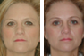 Endoscopic Browlift, Upper and Lower Eyelid Surgery