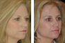 Endoscopic Browlift, Upper and Lower Eyelid Surgery