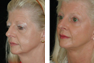 Facelift, Endoscopic Browlift, Upper and Lower Eyelid Surgery, Fat Grafting